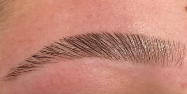Browlift